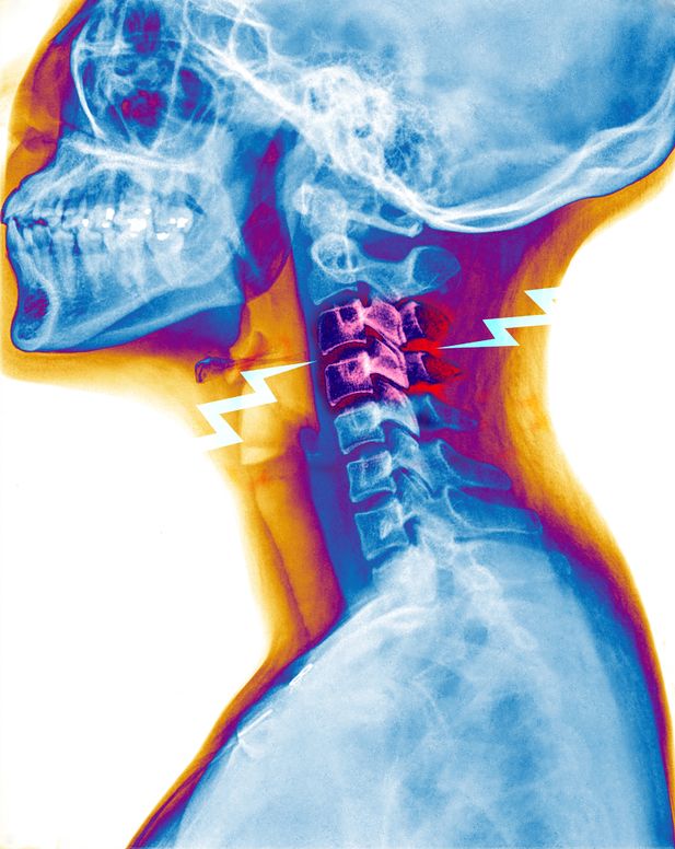 頸椎関節機能障害のイメージ図